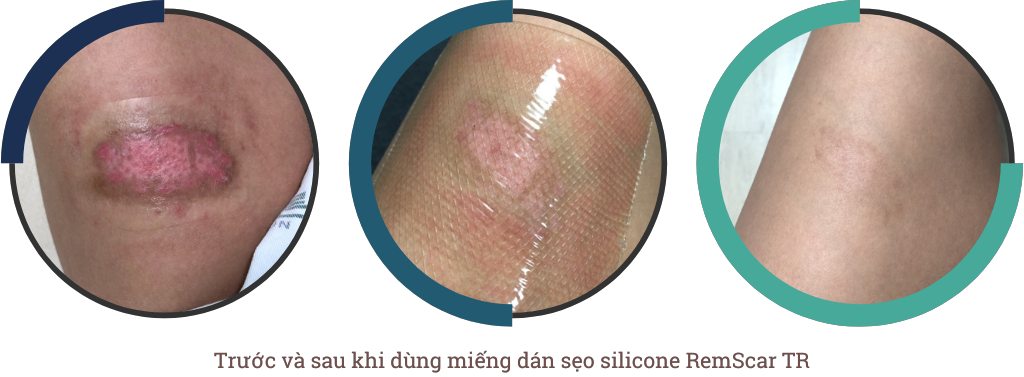 Sẹo bỏng sử dụng miếng dán sẹo RemScar TR