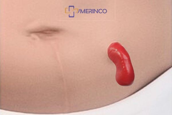 Biến chứng sa hậu môn nhân tạo