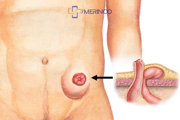 Cách điều trị thoát vị cạnh hậu môn nhân tạo