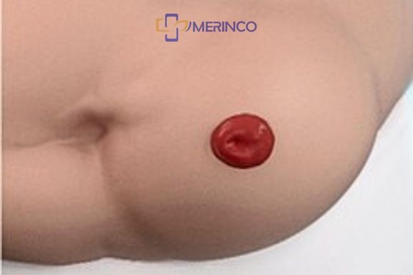 Biến chứng thường gặp ở hậu môn nhân tạo: Sa, thoát vị, tắc nghẽn