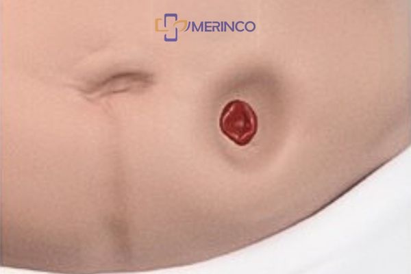 Biến chứng thường gặp ở hậu môn nhân tạo: Sa, thoát vị, tắc nghẽn