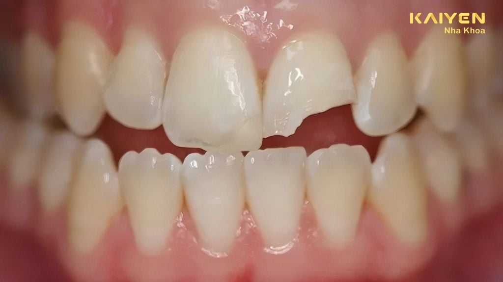 Làm gì để chăm sóc răng bị gãy? Ảnh hưởng khi răng bị gãy