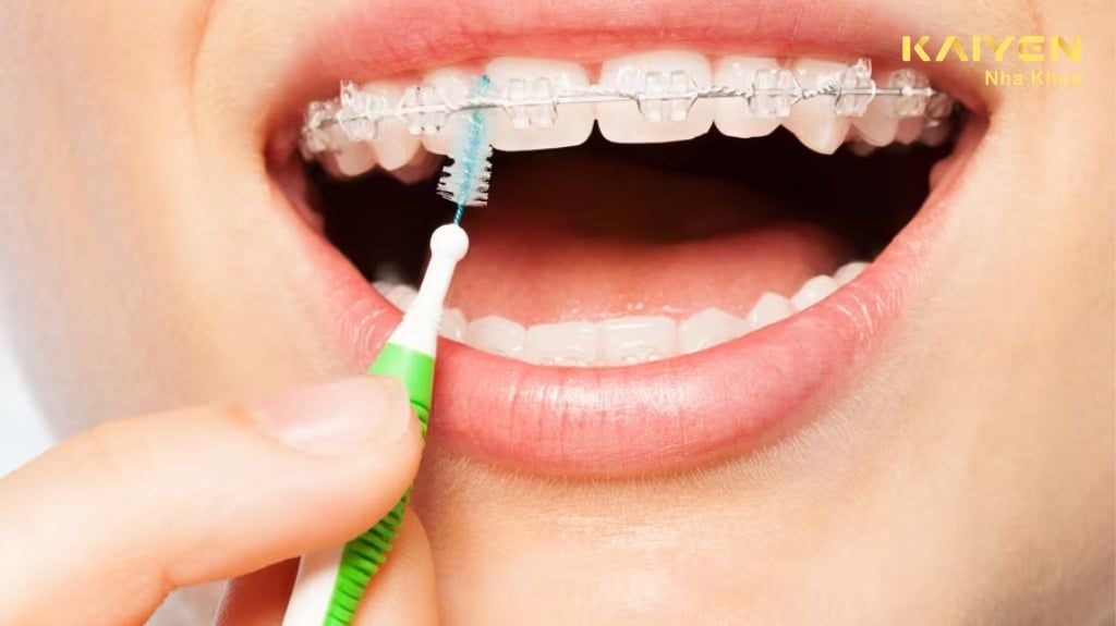 Bàn chải kẽ là gì? Cách sử dụng hiệu quả
