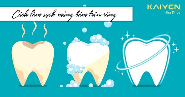 Bật mí các cách làm sạch mảng bám trên răng siêu hiệu quả