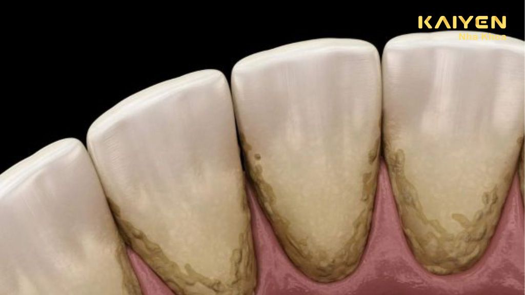Cạo vôi răng có bị mòn răng không? Có ảnh hưởng men răng không?