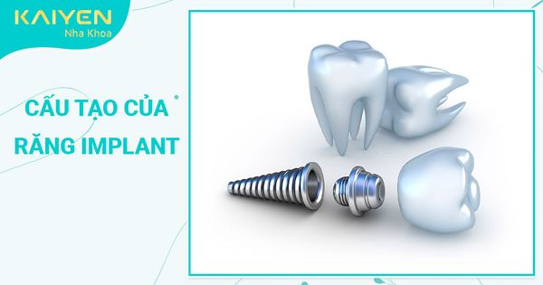 Cấu tạo của răng Implant và vai trò trong phục hình răng mất