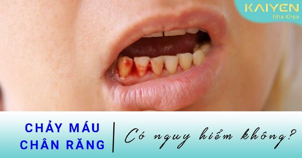 Chảy máu chân răng thường xuyên cảnh báo điều gì?