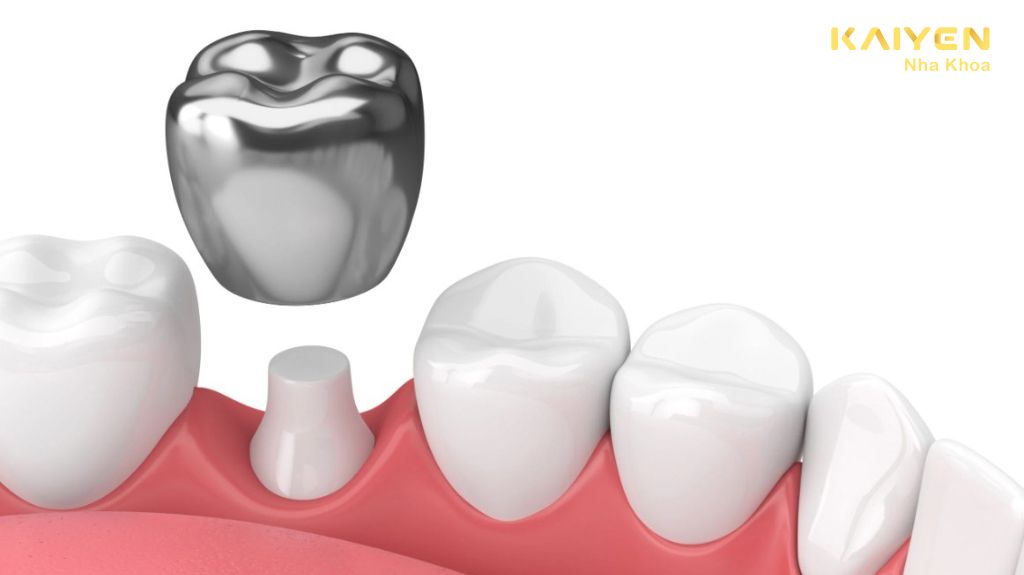Chụp thép răng sữa cho trẻ có nên hay không?
