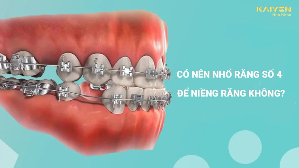 Có nên nhổ răng số 4 để niềng không? Khi nào nên nhổ răng?