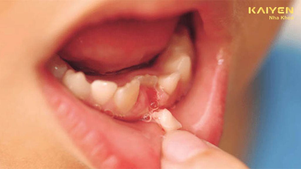 Có nên nhổ răng sữa chưa lung lay không? Có nguy hiểm không?