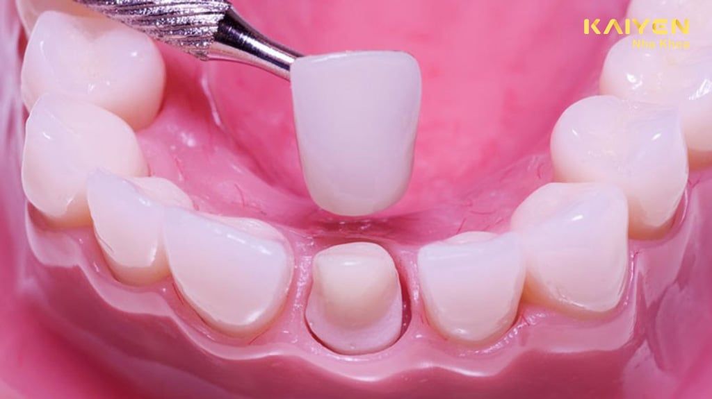 Làm cùi răng sứ giả là gì? Trường hợp nào nên gắn cùi giả