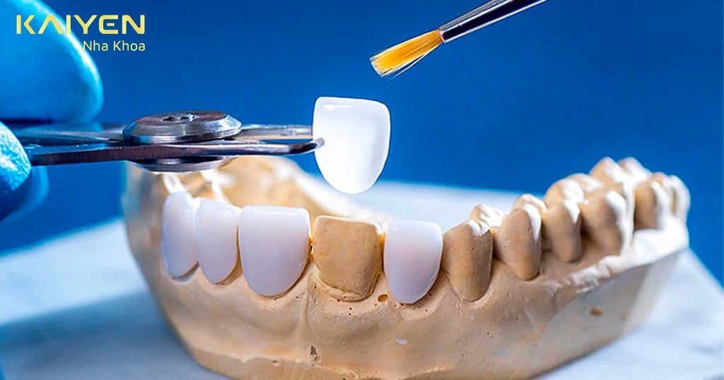 Dán sứ Veneer 2 răng cửa có tốt không? Giá bao nhiêu?