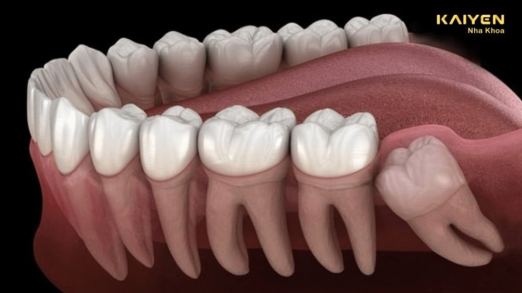 6 Dấu Hiệu Mọc Răng Khôn Dễ Nhận Biết
