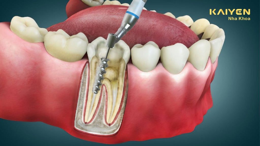 Khi Nào Cần Điều Trị Nội Nha? Quy Trình Điều Trị Như Thế Nào?