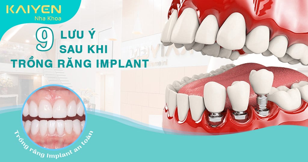 9 lưu ý sau khi trồng răng Implant nhất định bạn phải biết Nha khoa