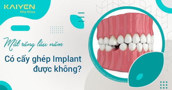 [Giải đáp] Mất răng lâu năm có cấy ghép Implant được không?