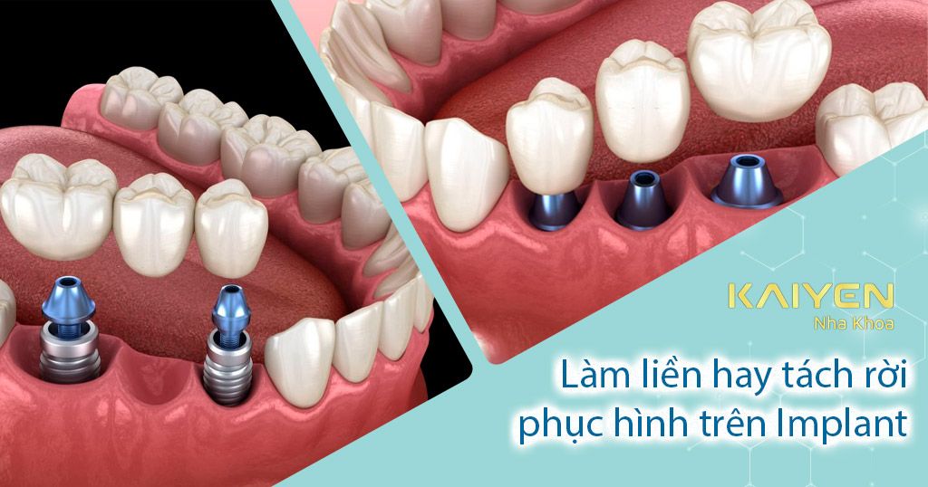 Làm liền hay tách rời phục hình trên Implant: Lựa chọn nào phù hợp?