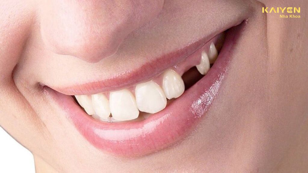 Răng nanh mọc ngầm là như thế nào? Có nên nhổ không?