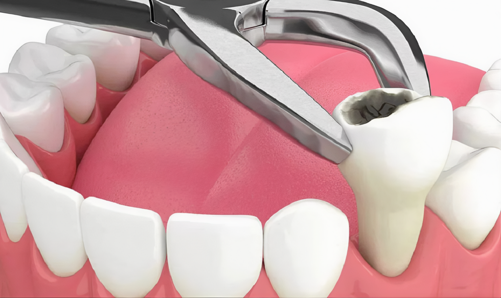 Nhổ Răng Hàm Có Đau Không? Các Trường Hợp Cần Nhổ Răng Hàm