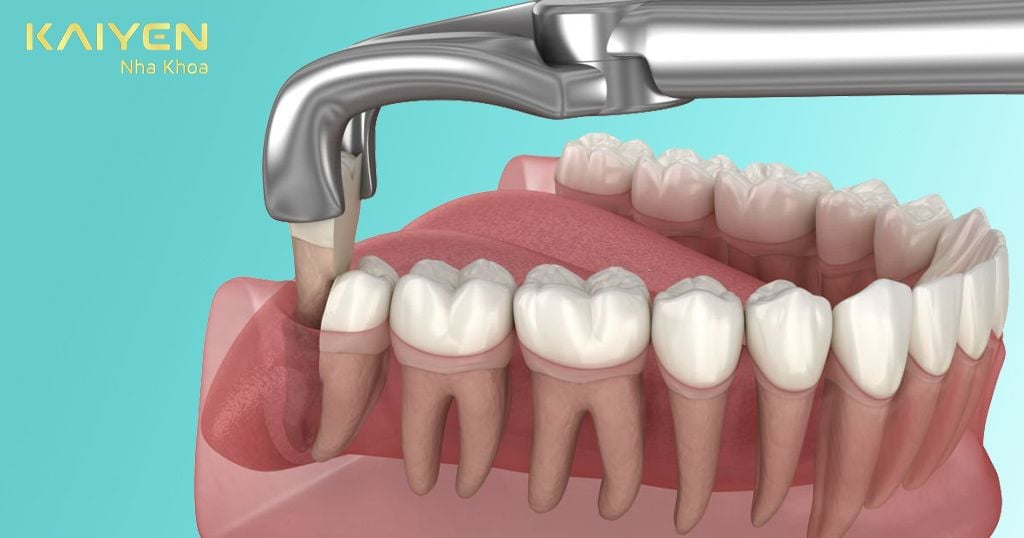 Nhổ Răng Khôn Hàm Dưới Có Gặp Nguy Hiểm Không?