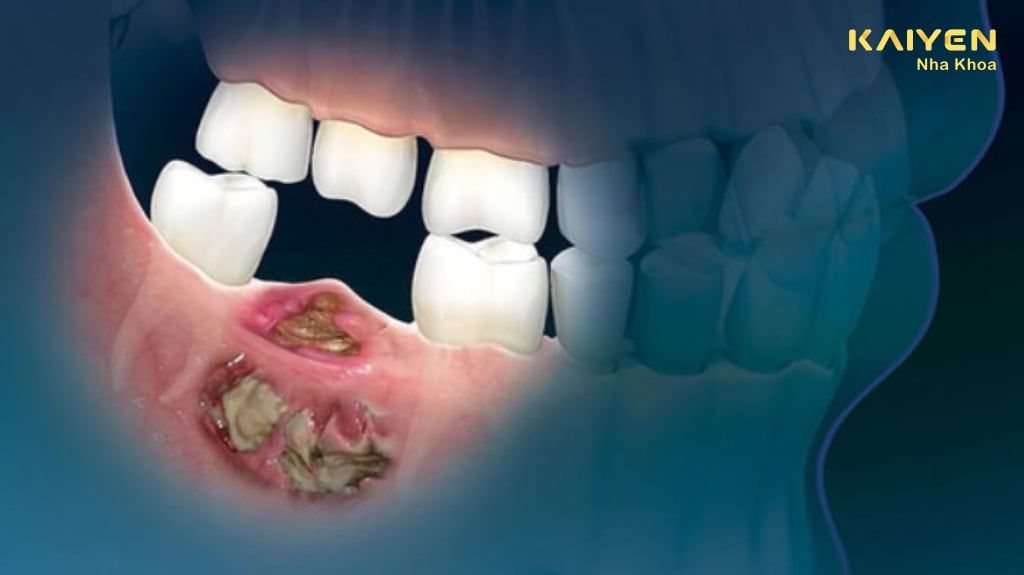 Nhổ răng lộ xương hàm do đâu? Các biến chứng có thể gặp phải