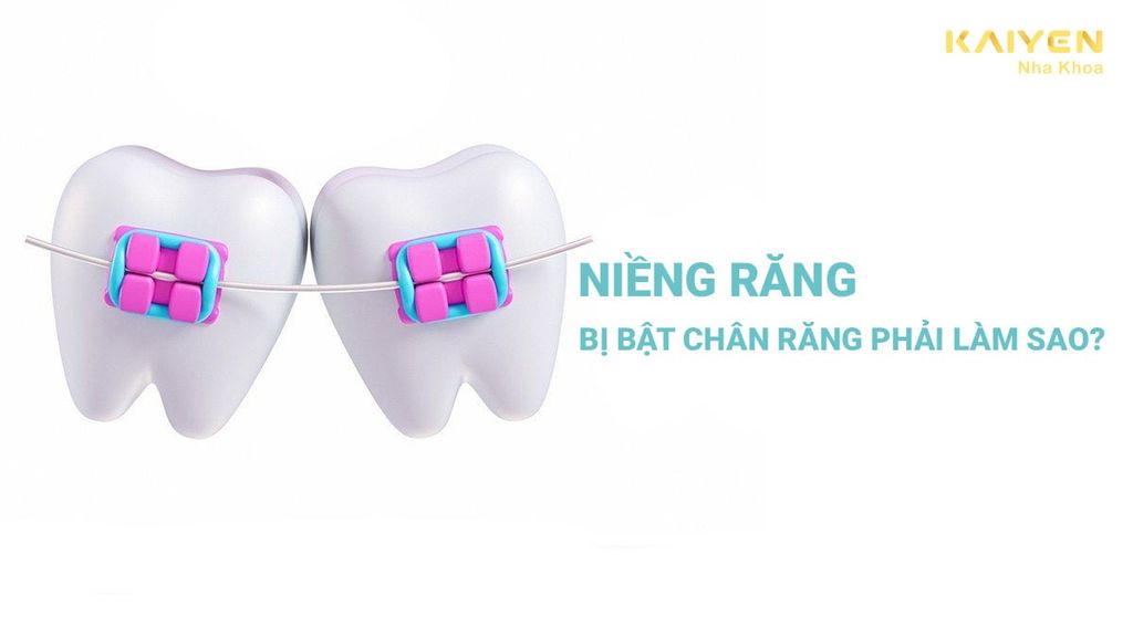 Niềng răng bị bật chân răng đâu là nguyên nhân gây nên?