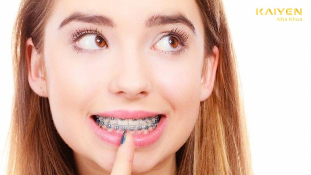 Niềng răng có giảm cân không? Nguyên nhân và cách khắc phục