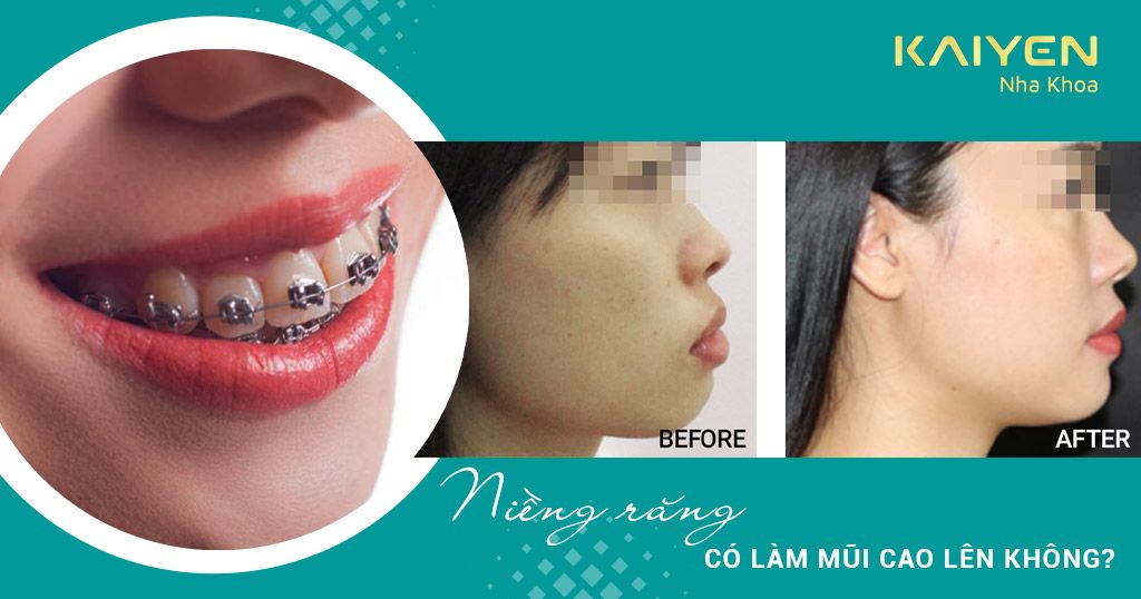 Niềng răng có làm mũi cao lên không? Gương mặt thay đổi như thế nào?