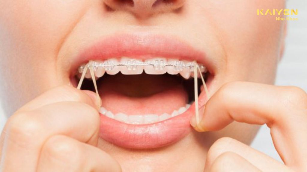 Nuốt dây thun niềng răng có sao không? Cách xử lý hiệu quả