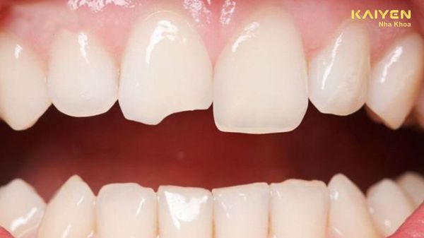 Răng mẻ thiếu chất gì? Cách khắc phục hiệu quả nhất