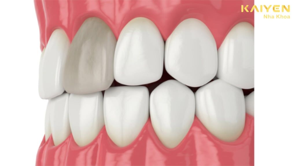 Dấu Hiệu Nào Cho Thấy Răng Chết Tủy