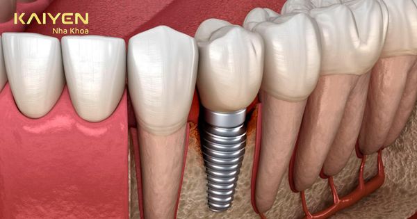 Răng Implant bị viêm là gì? Nguyên nhân, biểu hiện và cách điều trị?