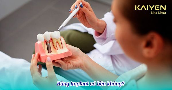 Răng Implant có bền không? Các yếu tố ảnh hưởng đến tuổi thọ của răng