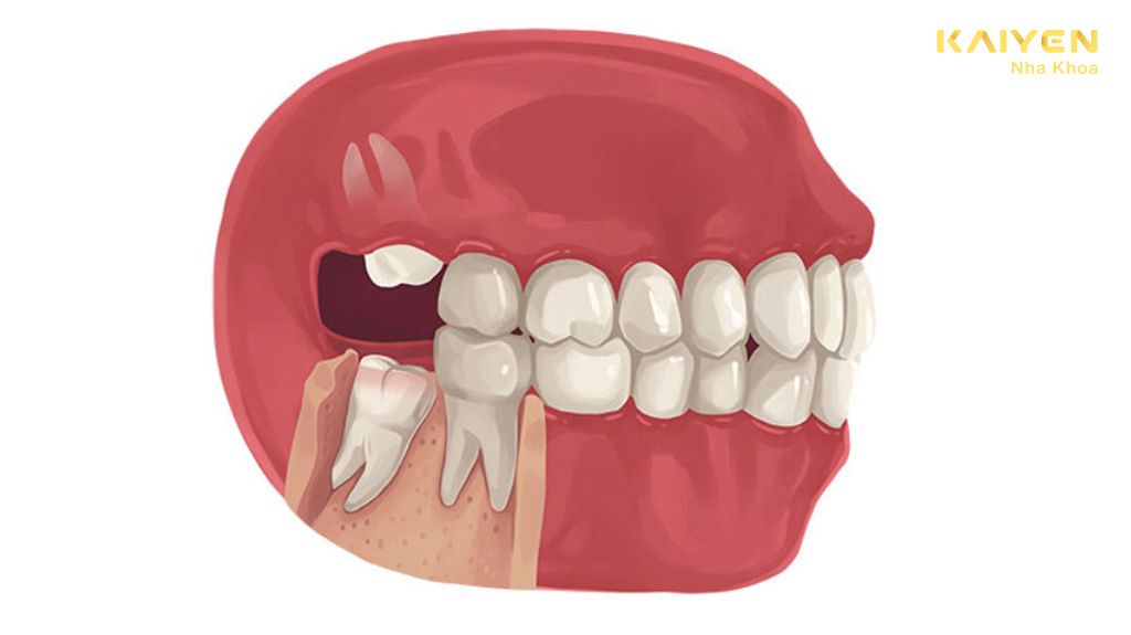 Răng khôn mọc lệch hàm trên khi nào cần phải nhổ?