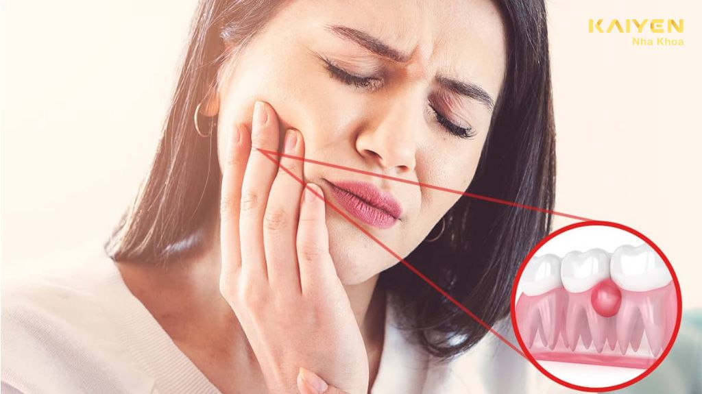 Răng Sâu Lồi Thịt: Nguyên Nhân Và Cách Điều Trị Triệt Để