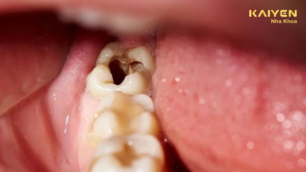 Răng Số 7 Bị Sâu Ảnh Hưởng Thế Nào Đến Sức Khỏe? Các Cách Điều Trị Sâu Răng Số 7