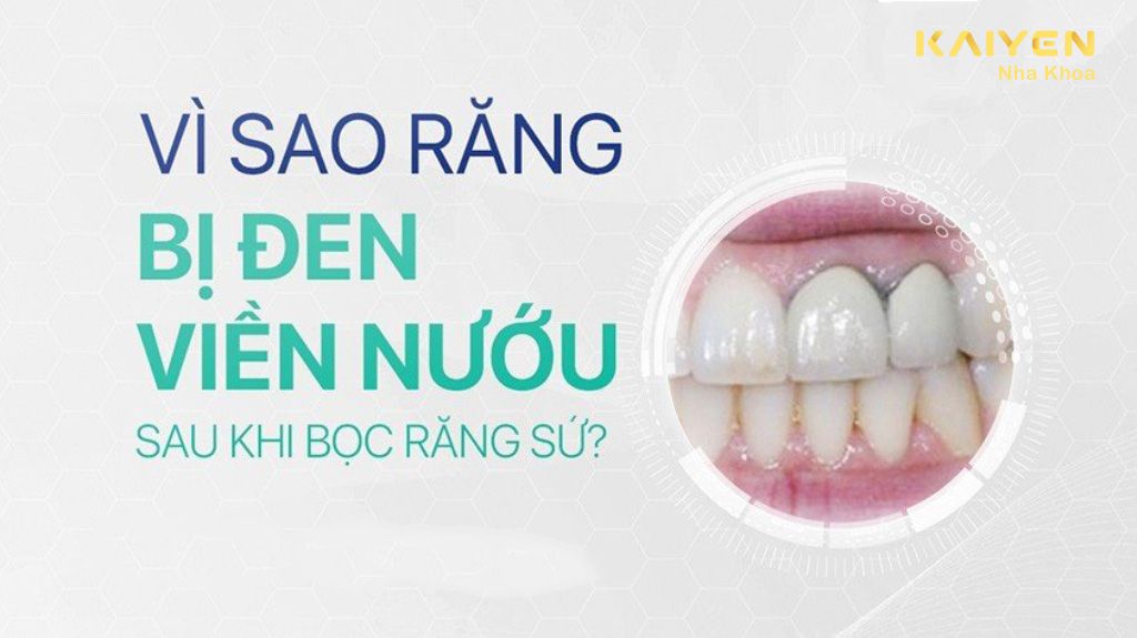 Vì Sao Bọc Sứ Bị Thâm Nướu? Cách khắc phục thế nào?