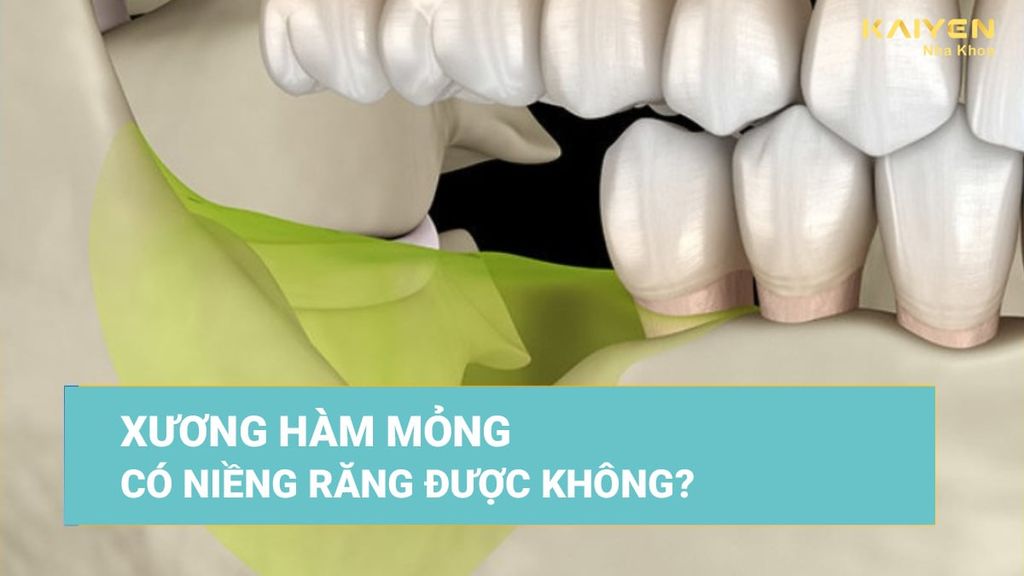 Xương hàm mỏng có niềng răng được không?
