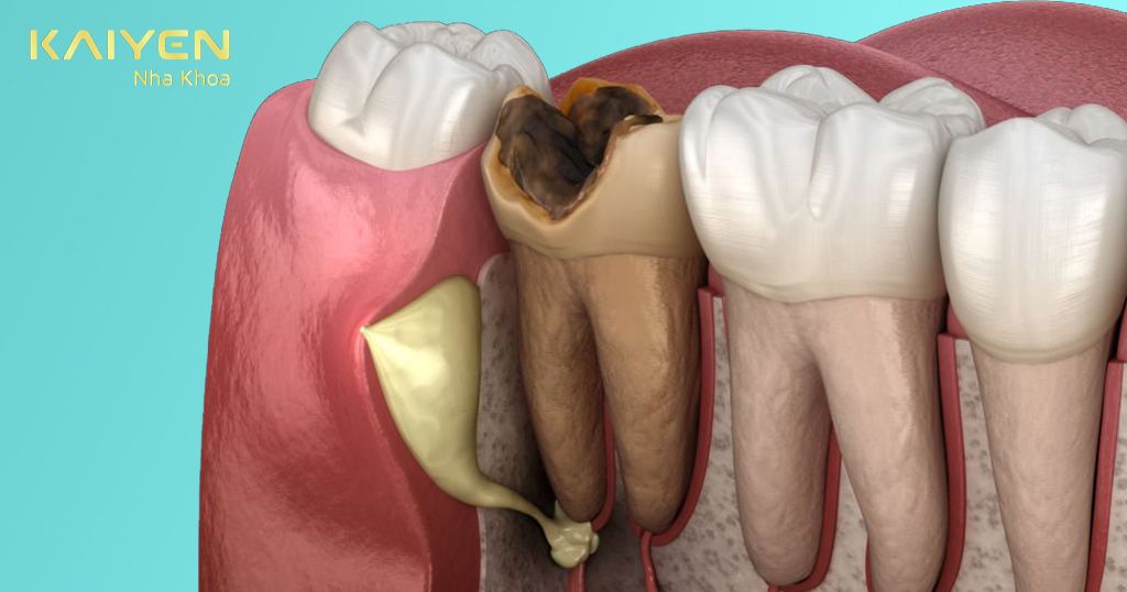 Sâu răng số 7 là một trong những biến chứng răng khôn thường gặp