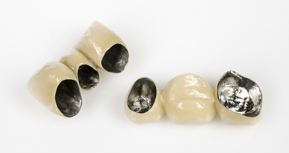 răng sứ kim loại