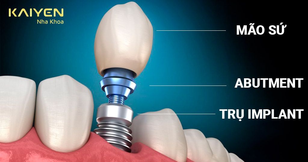 Trụ Implant thay thế chân răng đã mất
