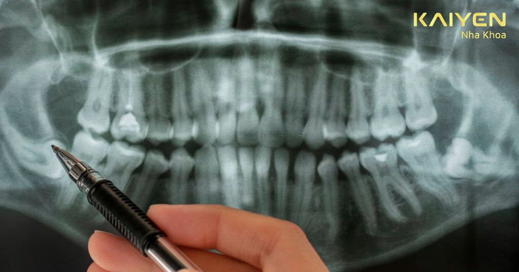 Chụp X-quang xác định tình trạng răng khôn mọc ngầm, lệch