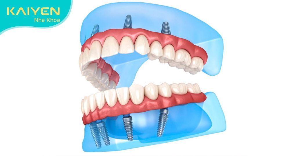 Cấy ghép Implant khi mất răng toàn hàm