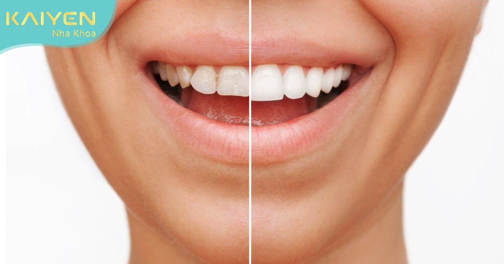 Phương pháp dán răng sứ mang lại nụ cười tự tin