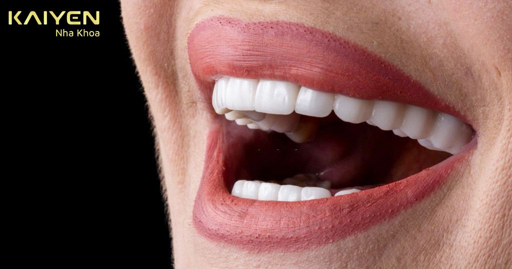 Răng sứ Veneer Emax có độ bền cao, giống với răng thật