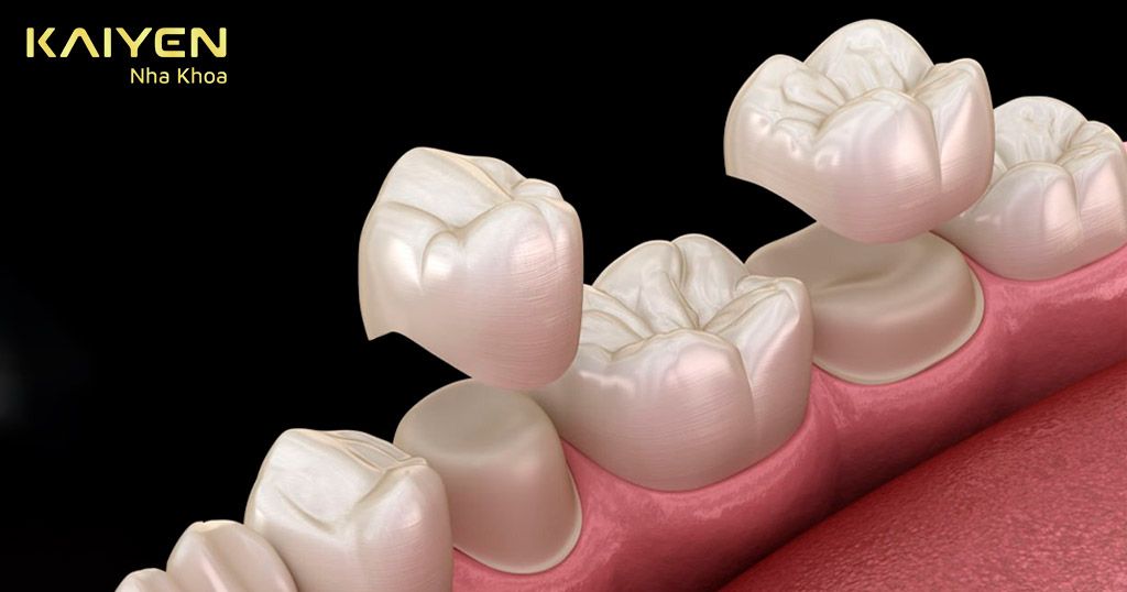 Bọc răng sứ tái tạo chiếc răng với hình dáng, màu sắc tương tự răng thật