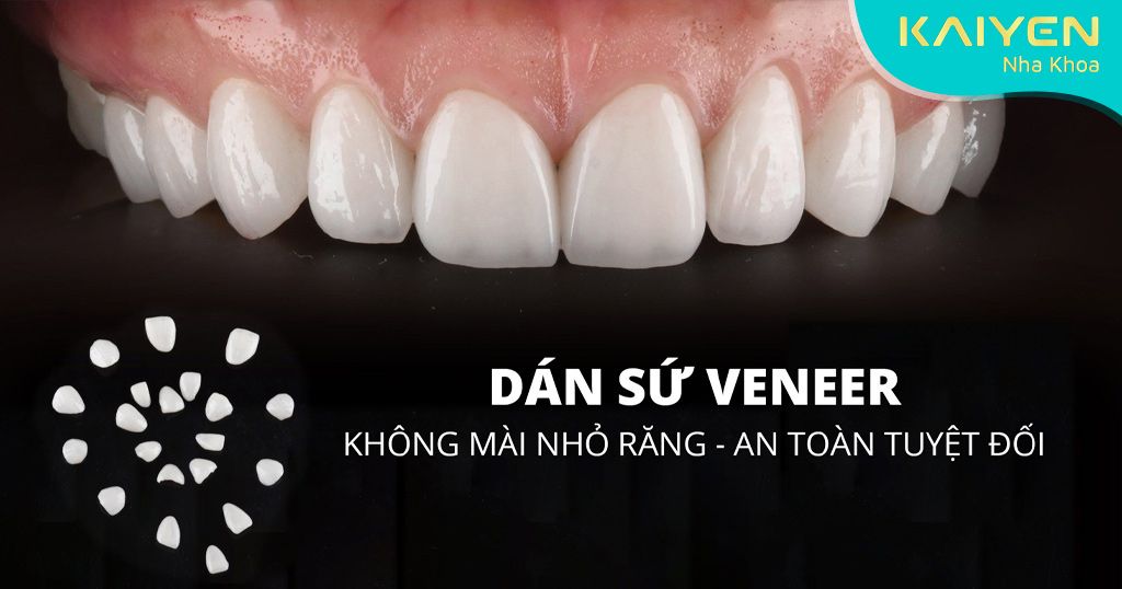 Răng sứ Laminate (sứ Veneer) an toàn, lành tính với sức khỏe