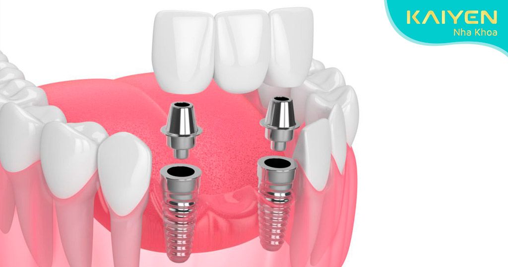 Trồng răng Implant với số lượng trụ răng ít hơn răng thật bị mất