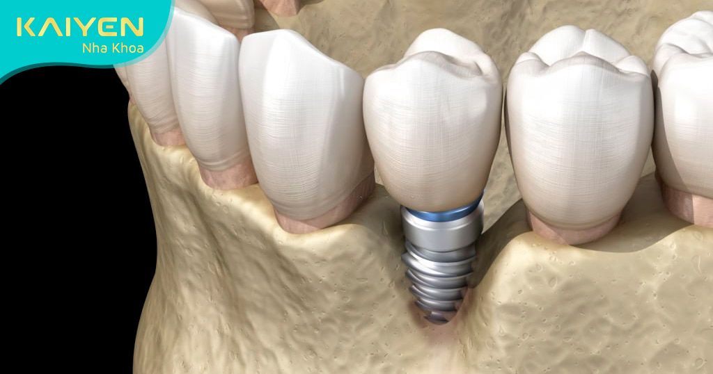 Xương hàm bị tiêu biến không ghép xương dễ dẫn đến cấy Implant thất bại