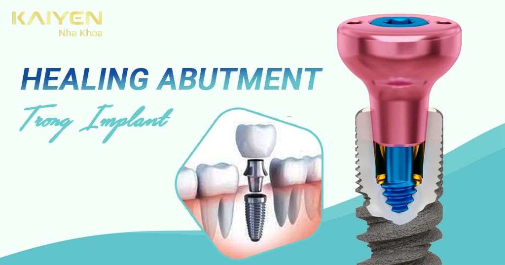 Healing Abutment trong trồng răng Implant